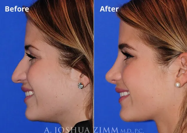 Naomi Olindo Rhinoplasty.jpg