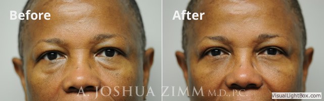 blepharoplasty20162