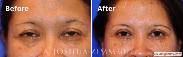 blepharoplasty20163