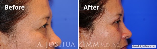 blepharoplasty20164