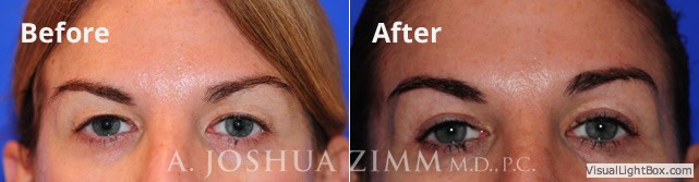blepharoplasty20165