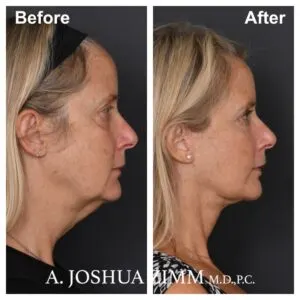 4 Facelift Before And After 3 300x300 1