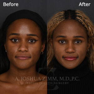 Woman before and after facial plastic surgery.