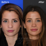 rhinoplasty_before_after