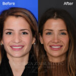 rhinoplasty_before_after