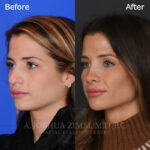 rhinoplasty_before_after