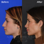 rhinoplasty_before_after