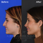 rhinoplasty_before_after