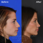 rhinoplasty_before_after
