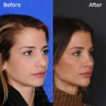 rhinoplasty_before_after