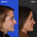 rhinoplasty_before_after