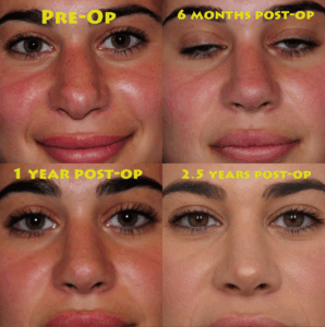 Progression of tip swelling after rhinoplasty. We can see how much more defined and refined her tip has become more than two years after her tertiary rhinoplasty. This is why it’s important to remain patient and trust the process during recovery, especially if someone has thick skin or had a revision