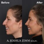 01.Rhinoplasty