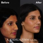 01.Rhinoplasty BeFore And After