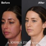 01.Rhinoplasty Before And After 1