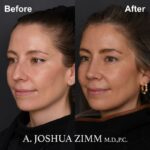 02.Rhinoplasty