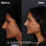 02.Rhinoplasty BeFore And After