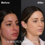 02.Rhinoplasty Before And After 1