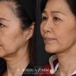 Facelift_Before_after