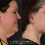 Facelift before after