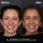 03.Rhinoplasty