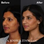 03.Rhinoplasty BeFore And After