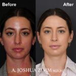 03.Rhinoplasty Before And After 1