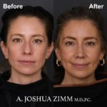 04.Rhinoplasty
