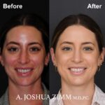 04.Rhinoplasty Before And After 1
