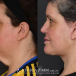 Facelift before after