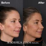 05.Rhinoplasty