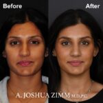 05.Rhinoplasty BeFore And After