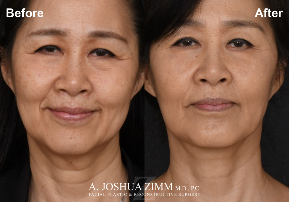 Facelift_Before_after