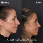 06.Rhinoplasty