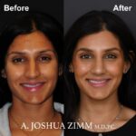 06.Rhinoplasty BeFore And After