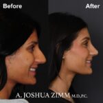 07.Rhinoplasty BeFore And After