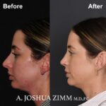 07.Rhinoplasty Before And After 1