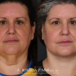 Facelift before after