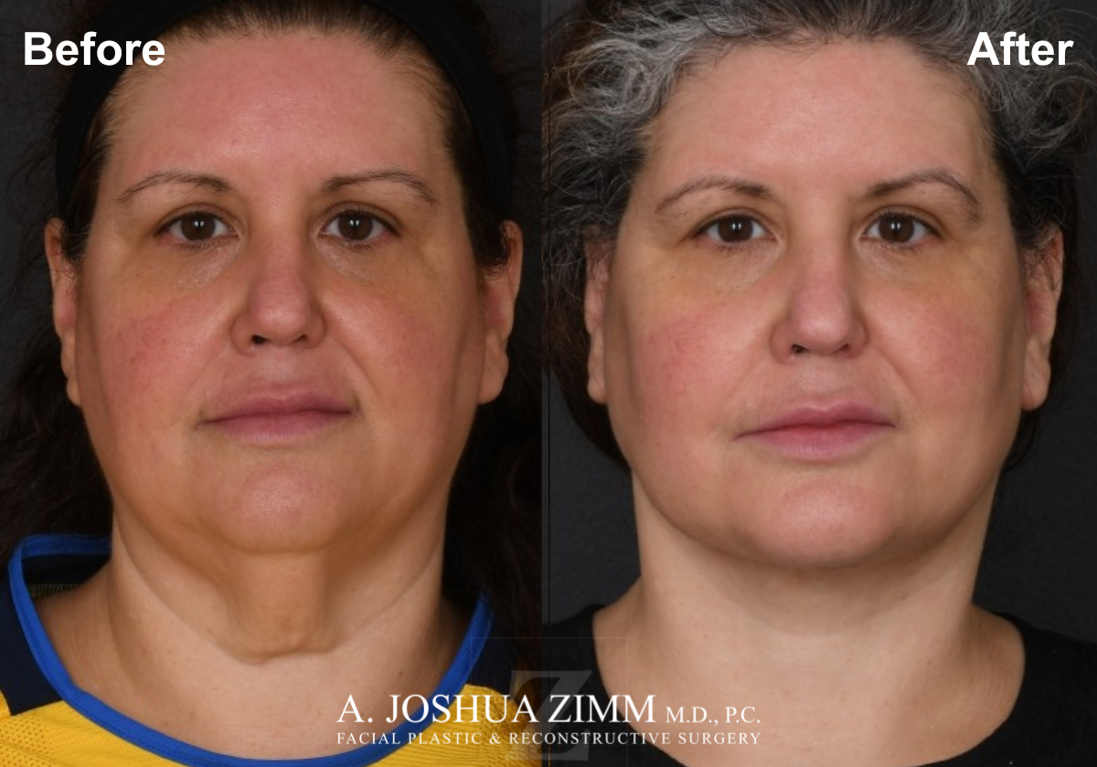 Facelift before after