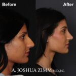 08.Rhinoplasty BeFore And After