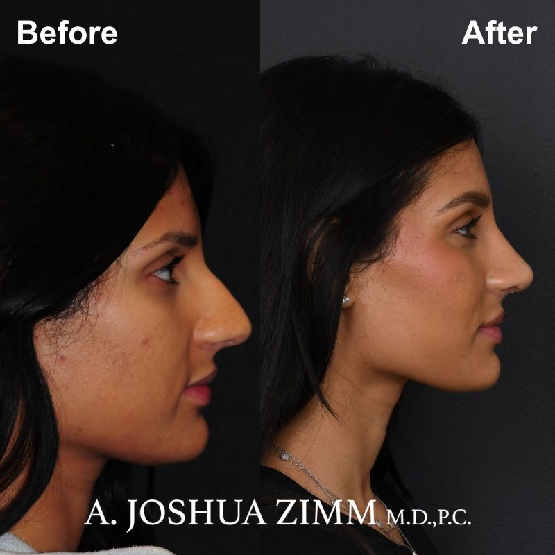 08.Rhinoplasty BeFore And After