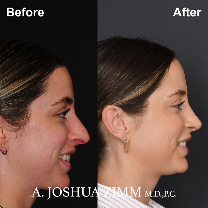08.Rhinoplasty Before And After 1