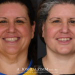 Facelift before after