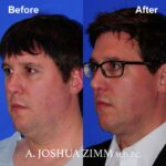 1 .FaceTite AccuTite Before And After