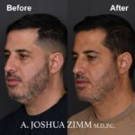 1 FaceTite AccuTite Before And After 1