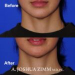 1 FaceTite AccuTite Before And After