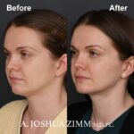 1 FaceTite AccuTite Before And After 2