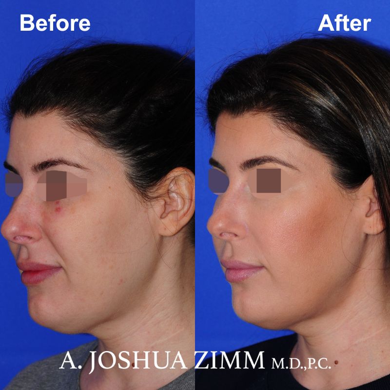 1 FaceTite AccuTite Before And After 3