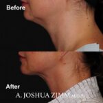 1 FaceTite AccuTite Before And After 4