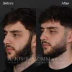 1 Month Post OSR L3.4V 1